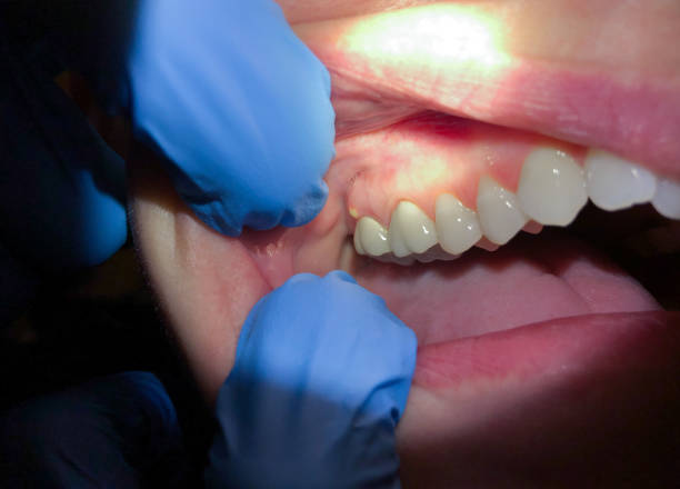 Best Emergency Wisdom Teeth Removal in Valley Falls, SC